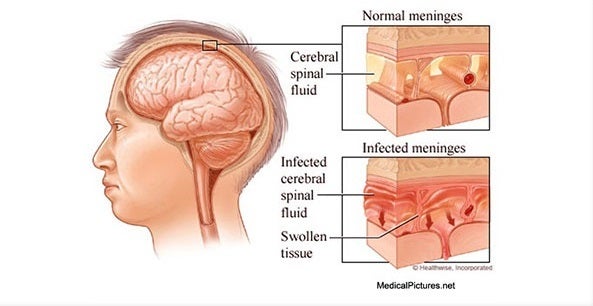 <p>Normal meninges vs infected meninges</p>