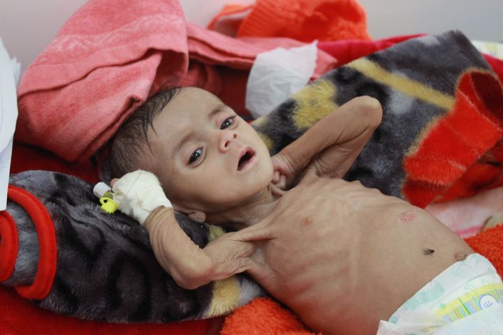 Seven-month-old Zainab Nawaf, who suffers from malnutrition, is pictured at UNICEF-supported Al-Jumhouri Hospital in Saada, Yemen, on Nov. 13, 2016.