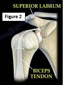 Biceps Tendon Pathology | HuffPost