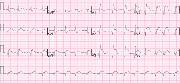 Heart Disease Is Not Hypothetical | HuffPost Life