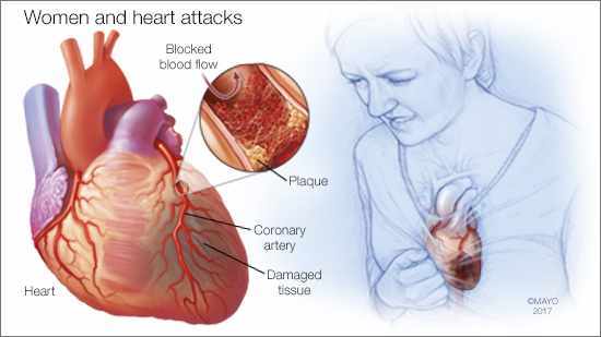 Image result for heart attack womens