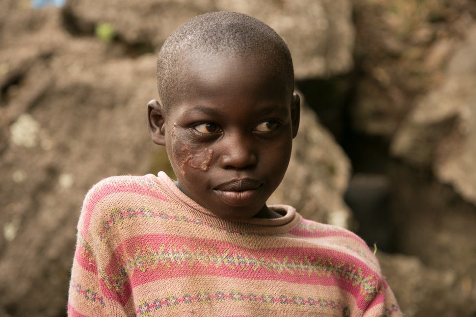 Daisy Chepsang, 10, bears the lesions caused by cutaneous leishmaniasis, which has plagued her impoverished community in a re
