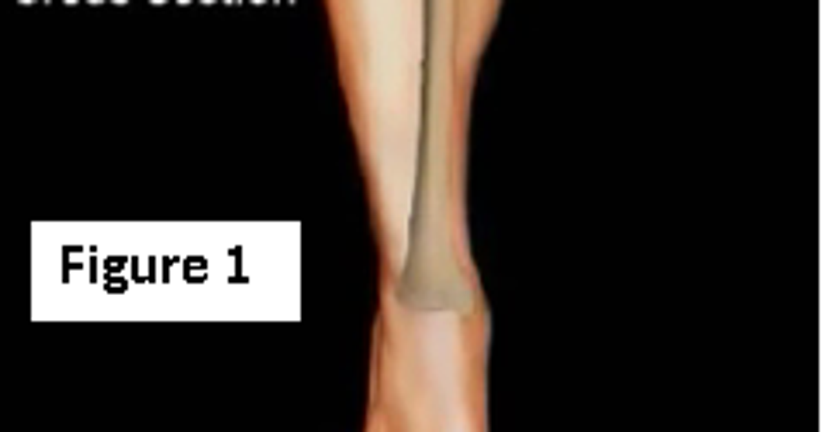 What is Compartment Syndrome? HuffPost Contributor