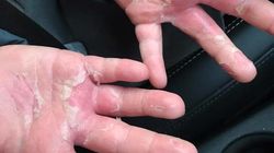 Mum Issues Warning After DIY Slime Left Her Daughter With 'Chemical Burns'