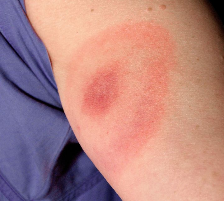 The pathognomonic erythematous rash in the pattern of a bull's-eye, which manifested at the site of a tick bite on a woman's posterior right upper arm. She subsequently contracted Lyme disease.