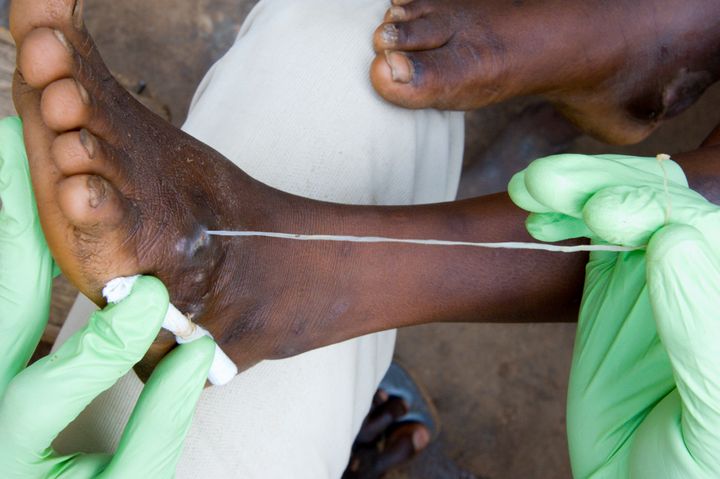 A Guinea worm emerges from a patient's foot.
