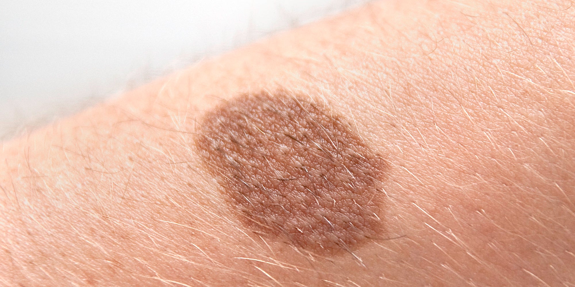 Cancerous Mole Symptoms Revealed In Animation Raising Awareness Of cancerous-mole-symptoms-revealed-in-animation-raising-awareness-of