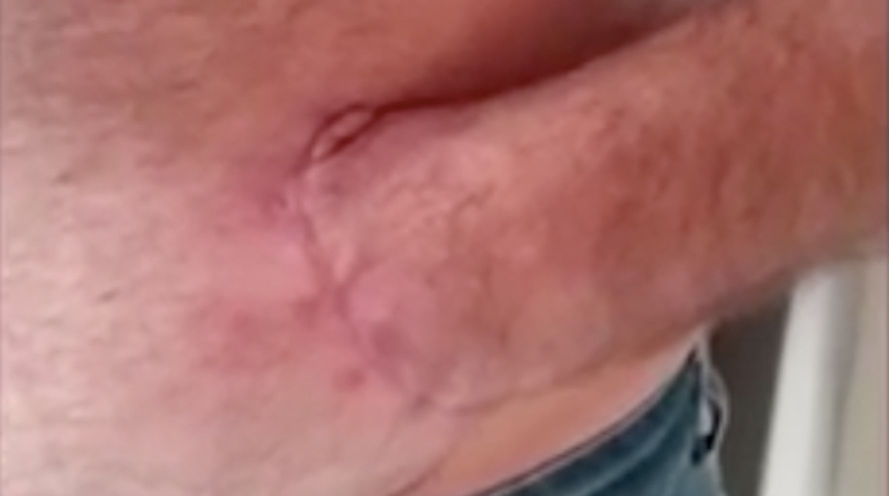 Man has hand sewn into his stomach to save it