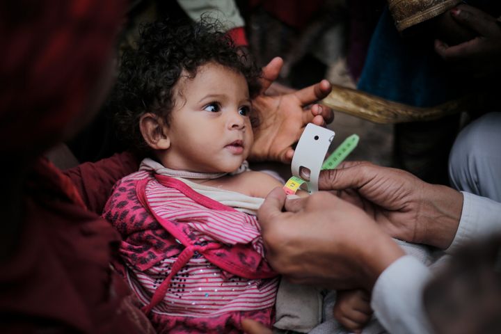 A medical practitioner uses a Mid Upper-Arm Circumference measuring tape on a child suffering from Severe Acute Malnutrition in Bani Al-Harith, Sana'a, Yemen, Tuesday 14 February 2017.