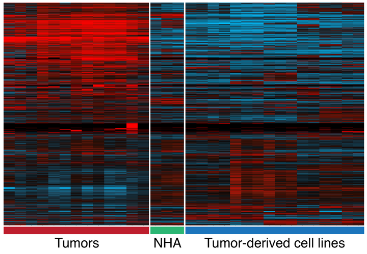 A heat map showing differences in gene expression between primary tumors and cultured cell lines. Each row is a gene and each column is a tumor or cell sample. In the heat map, red indicates high expression and blue indicates low expression. NHA refers to normal human astrocytes, a star-shaped glial cell of the central nervous system.