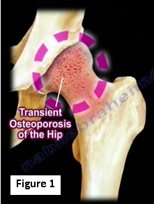 Transient Osteoporosis of The Hip joint Pain