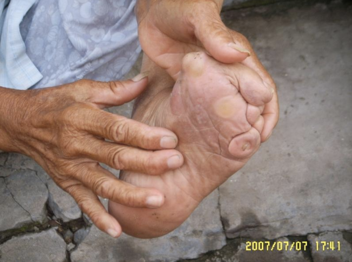 This woman's mother did not properly bind her feet. "That is, her mother lacked expertise so that the feet did not achieve the desired shape, but were nonetheless painfully deformed," Bossen explained.