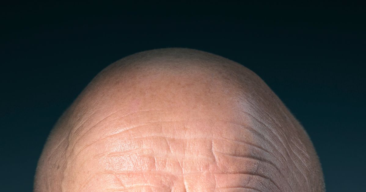 Scientists Could Treat Baldness After Discovering What Causes It