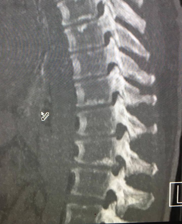 Image of the spine