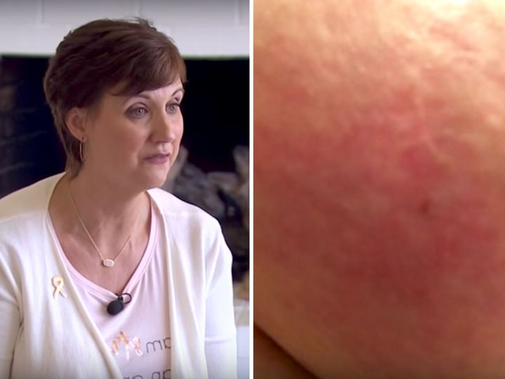 Woman Shares Photo Of Inflammatory Breast Cancer Symptom In Hope