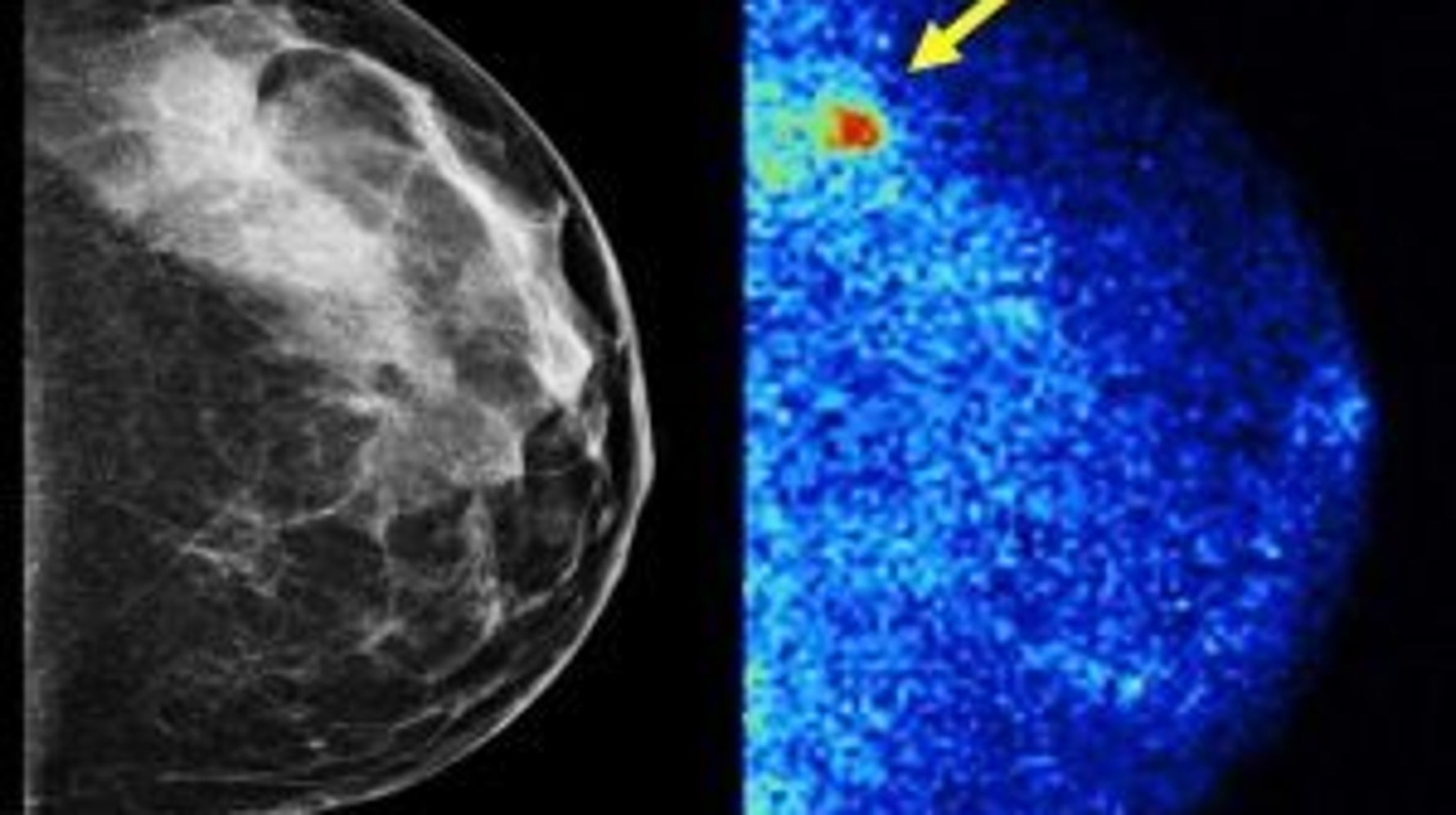 3D Mammograms And Molecular Breast Imaging Personalized Approaches