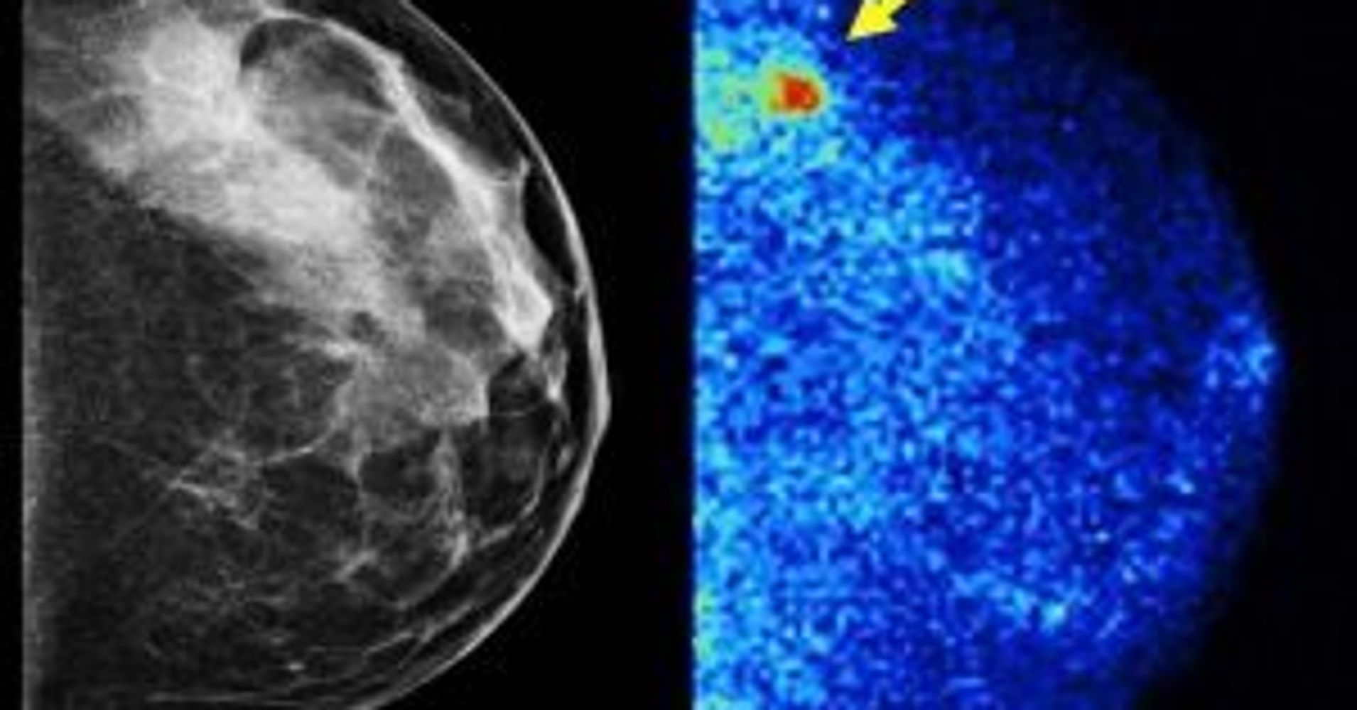 3 D Mammograms And Molecular Breast Imaging Personalized Approaches To Breast Cancer Screening