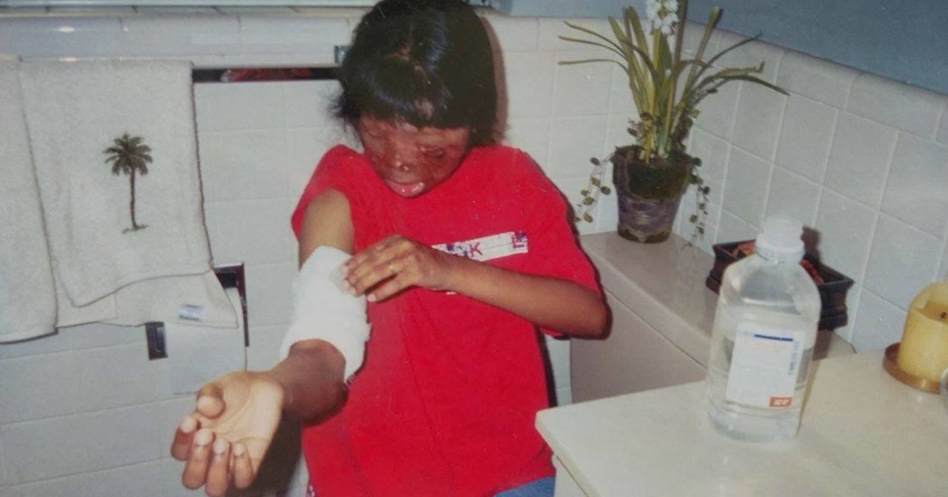 At Age 9, She Survived A Brutal Acid Attack. Here's Her Life 18 Years