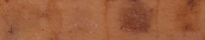 According to Fisher, the above illustrates four samples of human pigmentation. The two sections on the right are shown after treatment with SIK inhibitors that can penetrate, the second from left shows treatment with SIK inhibitors that did not penetrate well, and the far left shows one control group sample with no pigmentation.