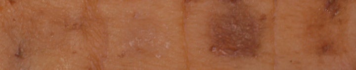 According to Fisher, the above illustrates four samples of human pigmentation. The two sections on the right are shown after treatment with SIK inhibitors that can penetrate, the second from left shows treatment with SIK inhibitors that did not penetrate well, and the far left shows one control group sample with no pigmentation. 