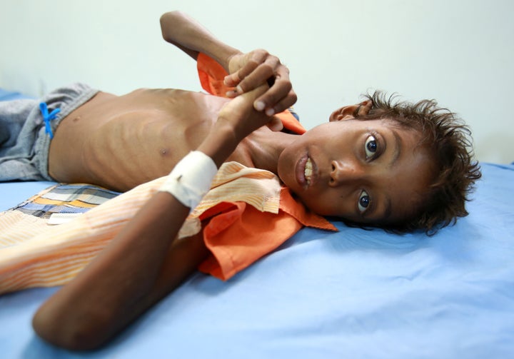 More than 2 million children are acutely malnourished in Yemen, according to the United Nations.