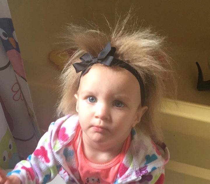 Phoebe Brasswell, of Smithfield, North Carolina, was born with a rare condition that makes her hair untamable.