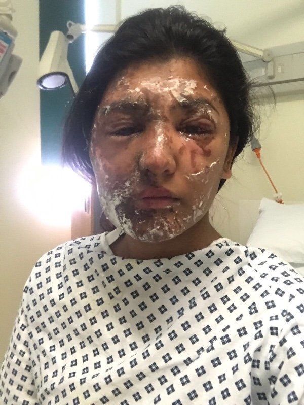 Khan suffered burns to her arms, legs, face and shoulder and will need skin grafts 