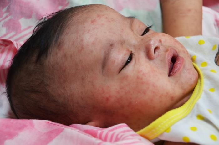 Measles Is Back.