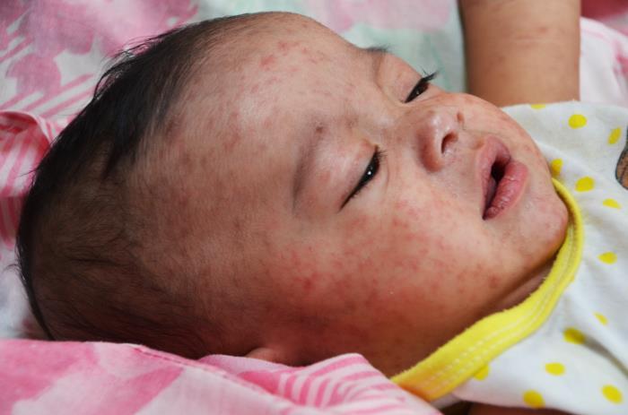<p>Measles Is Back.</p>