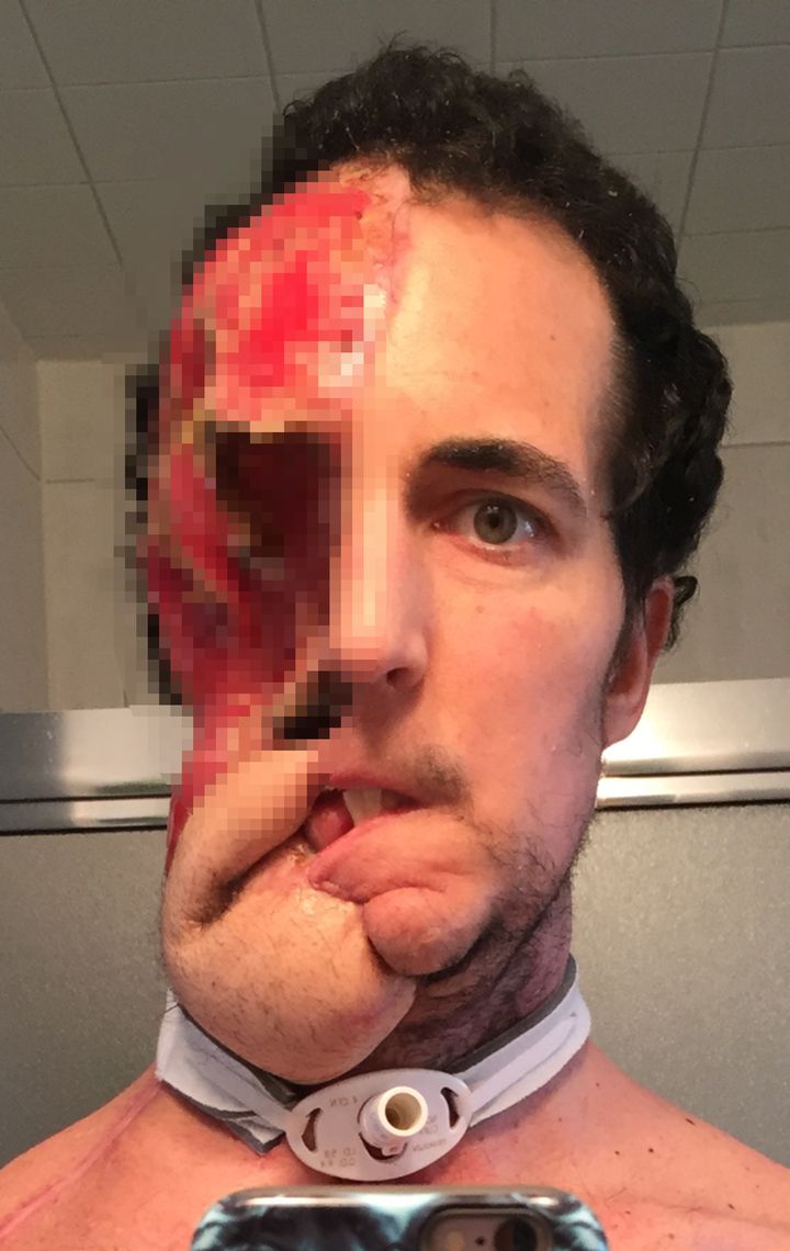 Eventually the tumour was cut out, but his body rejected multiple efforts to rebuild his features and McGrath was forced to live with exposed flesh for a year 