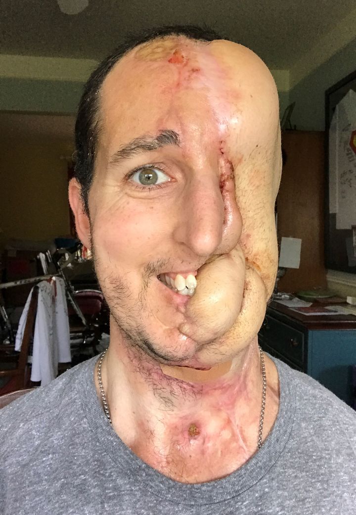 Now McGrath has had his face partially reconstructed - using skin from his leg and forearm 