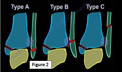 Ankle Fractures | HuffPost