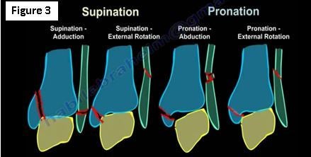 Ankle supination trauma