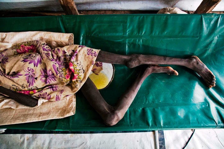 Duor Jany, 11, seriously affected with cholera, lays on a bed, at a clinic in Lankien, Jonglei, South Sudan on July 5, 2