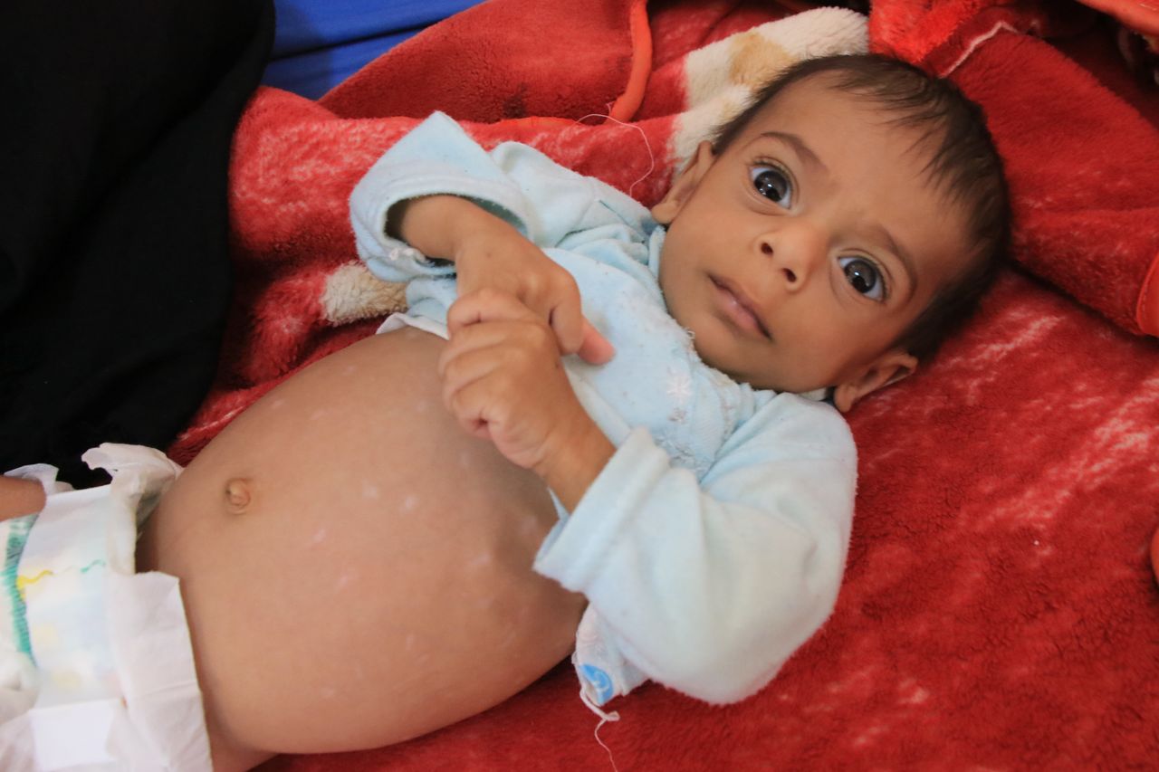 Ten-month-old Naji suffered from a severe type of malnutrition called kwashiorkor.