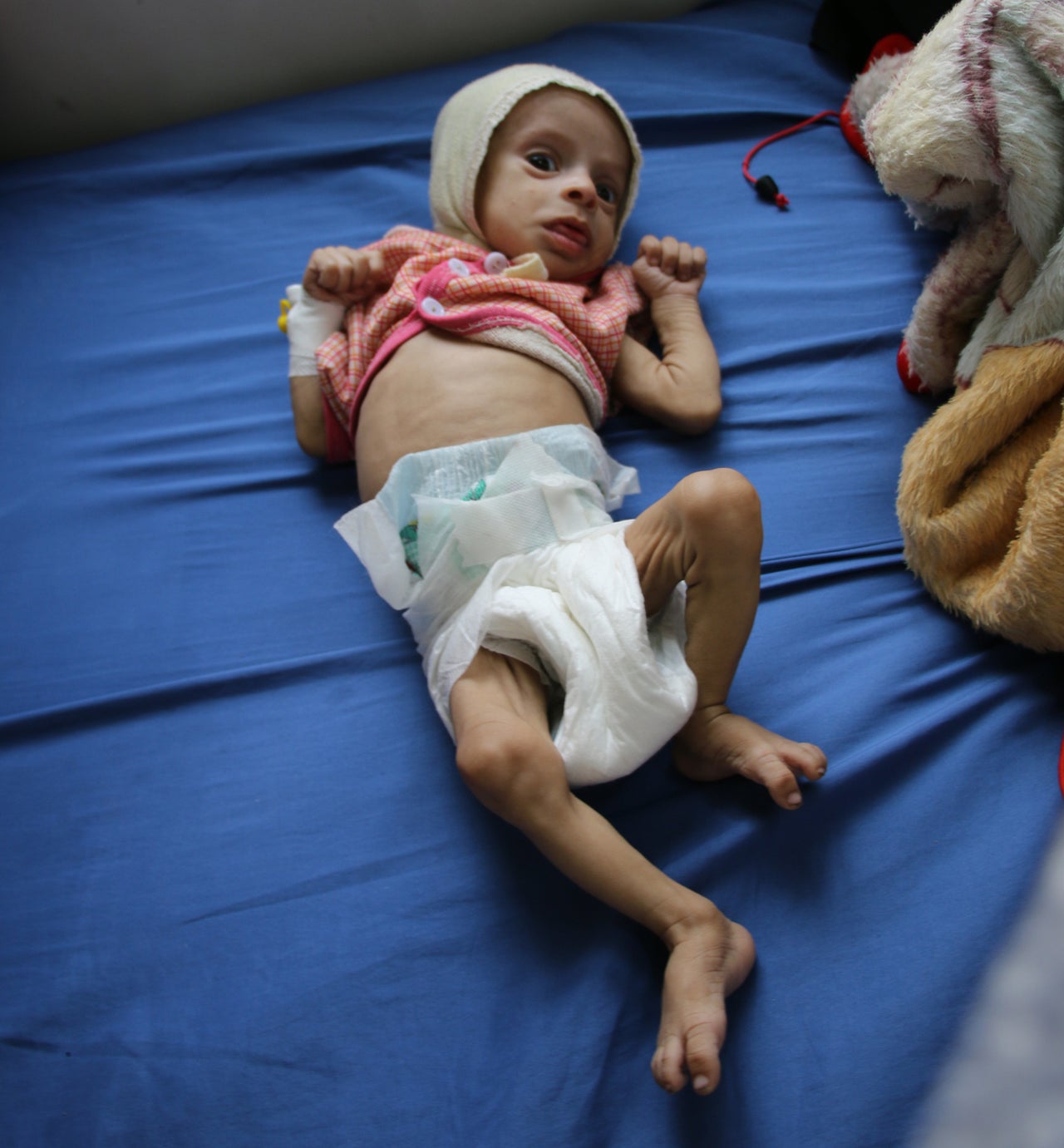 Three-month-old Ishraq Ali was diagnosed with severe malnutrition.