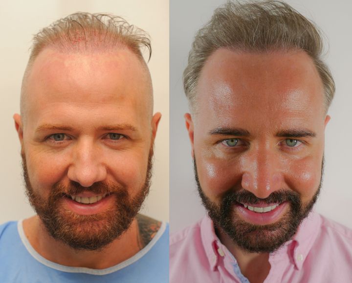 Before and after: Chris underwent another hair transplant ahead of his big day.