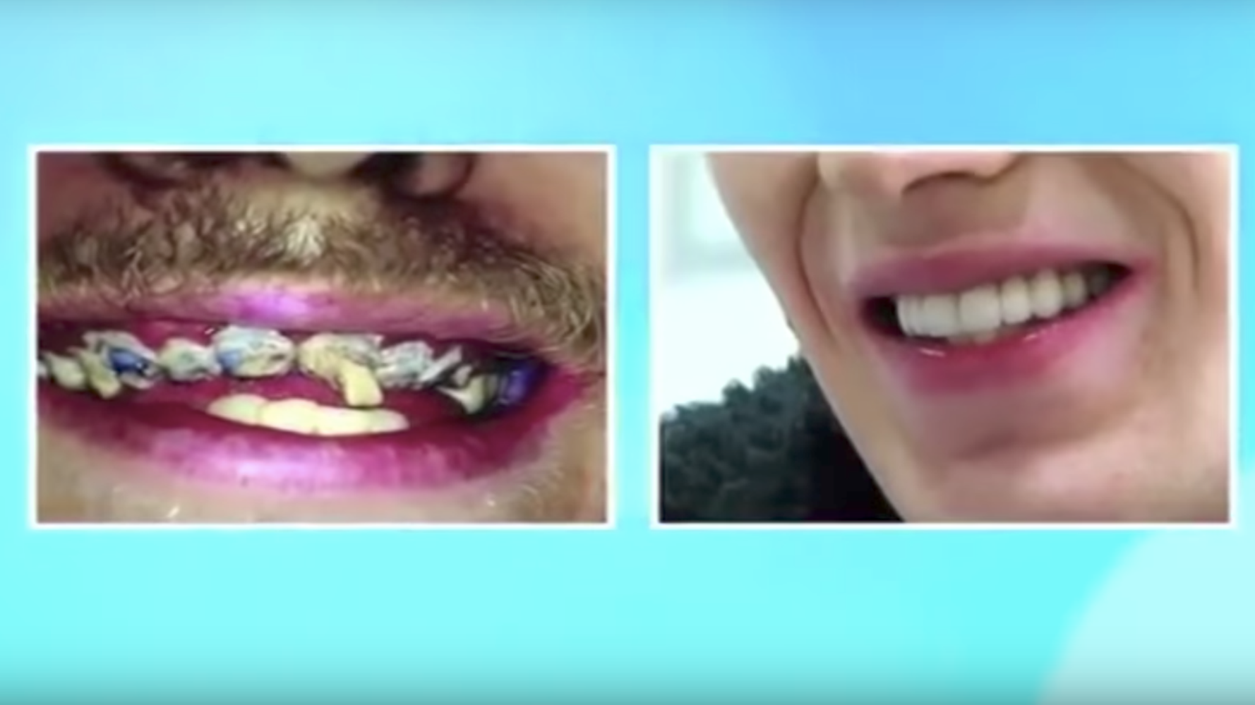 Black Stuff On My Teeth When I Wake Up - TeethWalls
