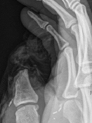 An X-ray showing Mitchell's lost thumb. 