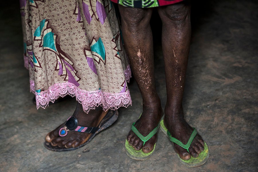 Leopard skin, one of the symptoms of river blindness.