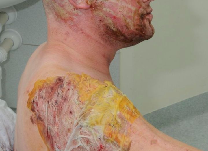 A police handout image of a man recovering after an acid attack. There has been a spate of acid attacks in recent weeks.