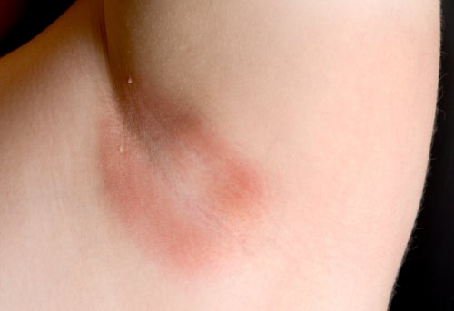Fit Rash Fungal Rash On Armpit Treatment