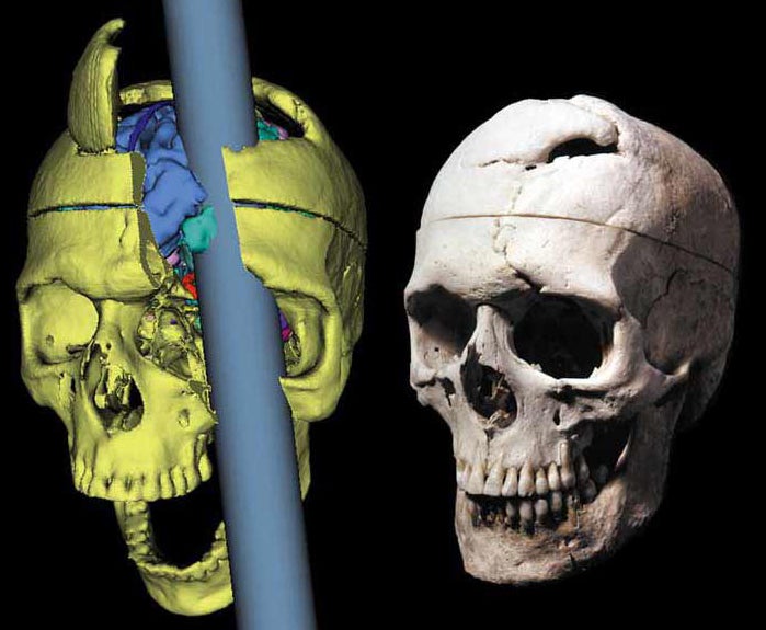 Trajectory of the 43 inch tamping iron that traveled through the head of railroad foreman Phineas Gage on September 13th 1848. The iron’s violent path removed the entire front portion of his brain. His skull and the original iron that went through it are still on public display in the Warren Museum at the Harvard Medical School in Massachusetts.