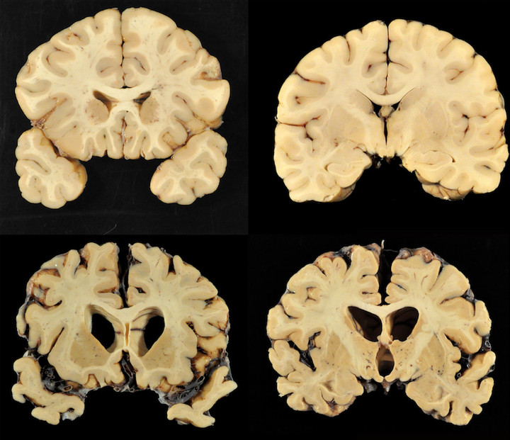 A number of the brains studied by doctor Ann McKee and her researchers. Almost all of the brains McKee has studied were found to have CTE.