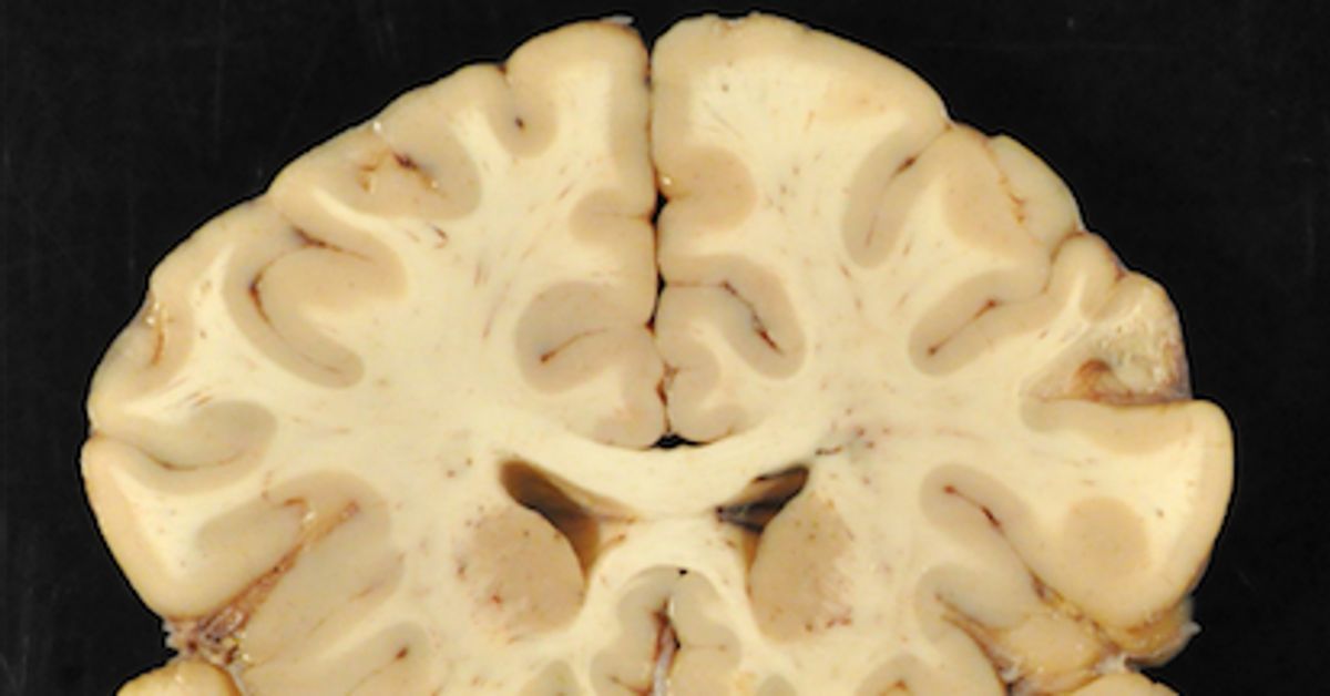 NFL CTE Study Reveals Football's Cruel New Math