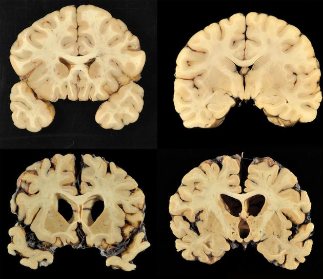 99 Percent Of Studied Nfl Brains Diagnosed With Cte