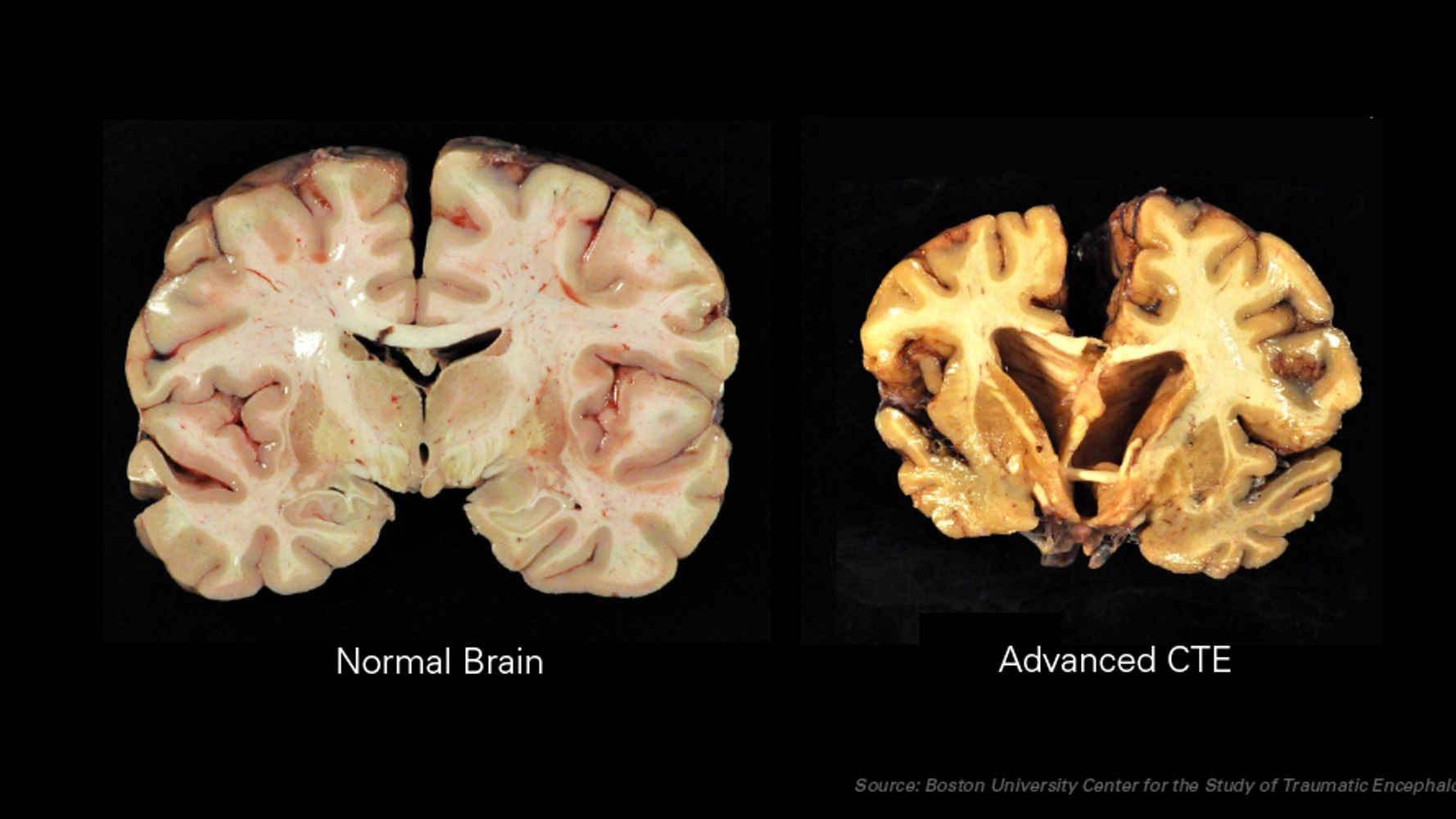 Study: 110 of 111 brains, including three former Dolphins, had CTE