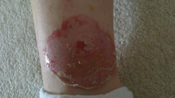 Horse Fly Bite Treatment For Dogs Horse Fly Bite Treatment For Dogs