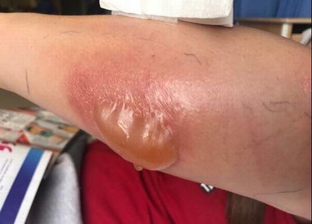 A photo of a reader's horsefly bite sent to MEN.