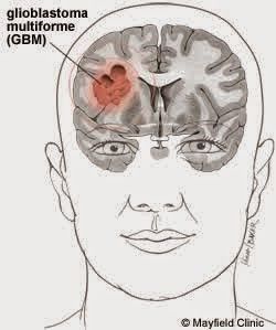 Glioblastoma, a rare but aggressive cancer, represents 15% of all brain tumors.